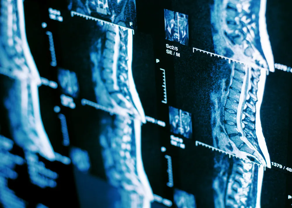 What Kinds of Damages Can You Seek After Sustaining an SCI?
