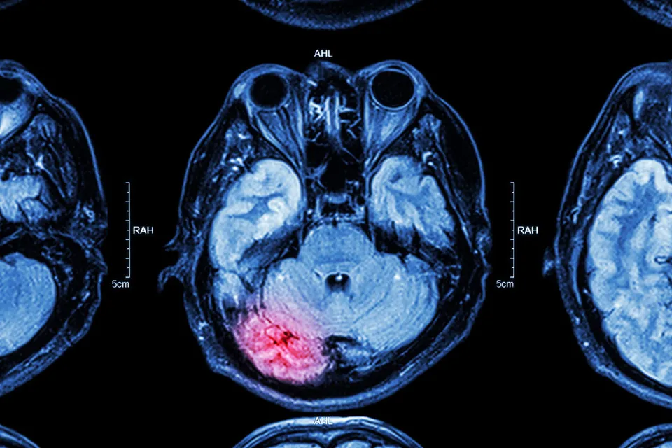 5 Strategies for Building a Strong Brain Injury Claim