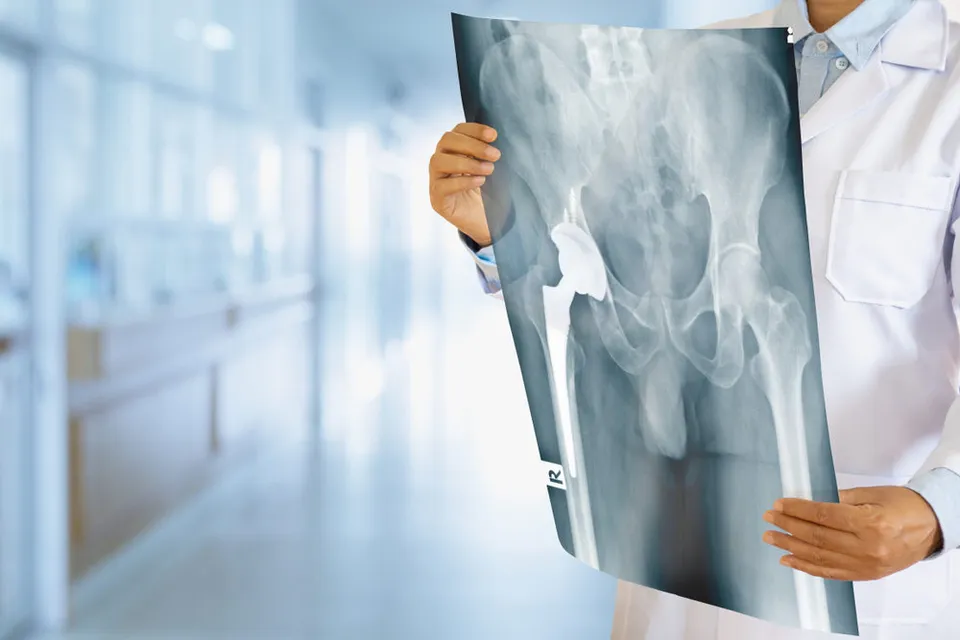 Optetrak, Trulliant and Vantage : Recall on the Exactech Knee, Ankle and Hip Replacements